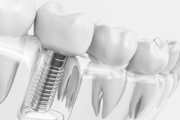 Dental Implant