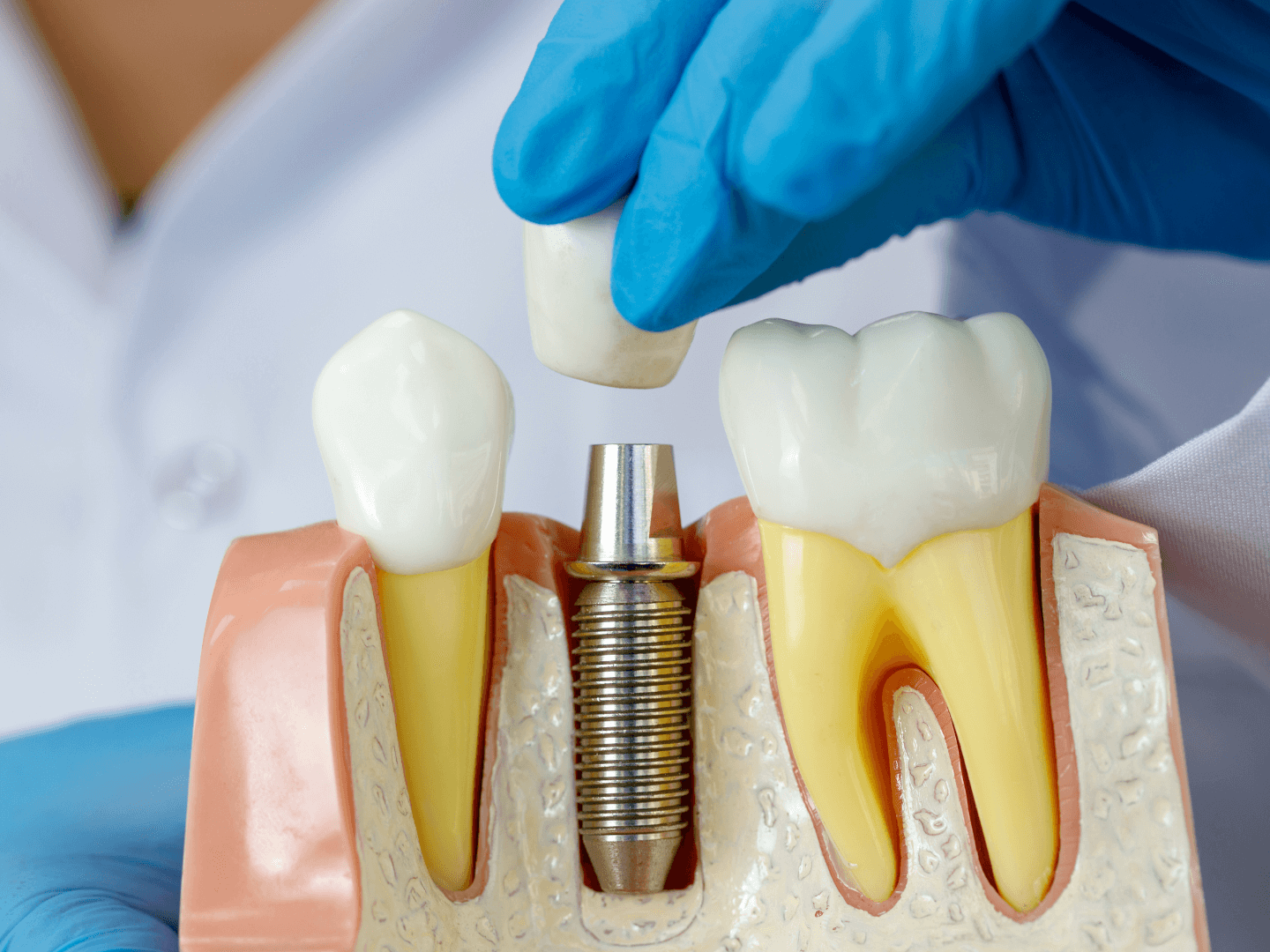 Dental Implant