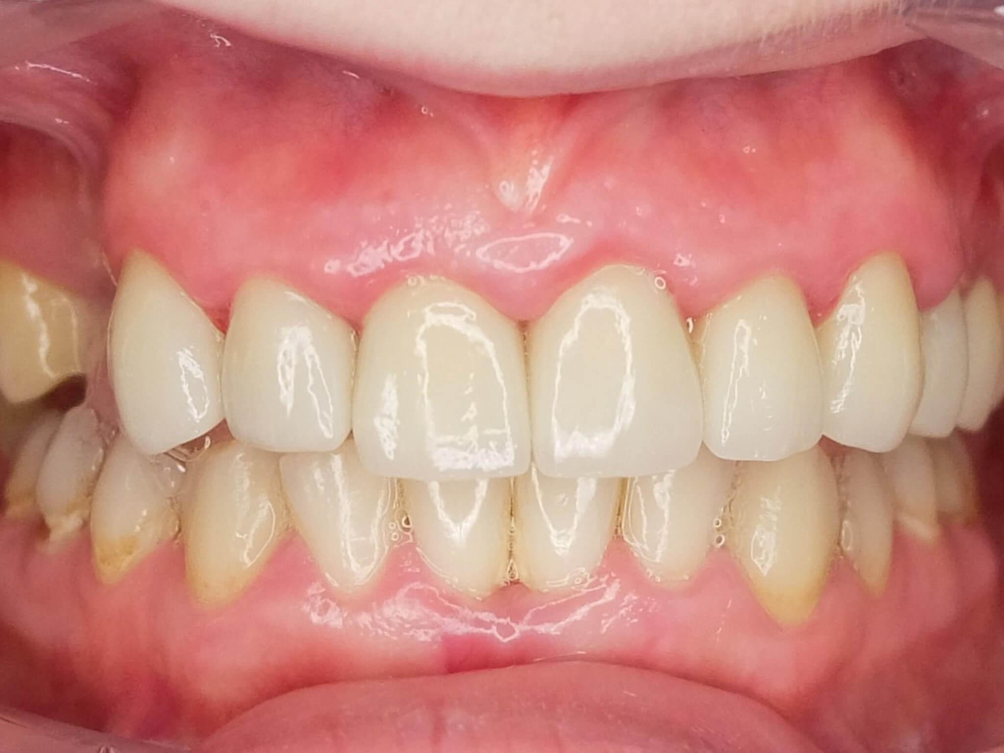 after Veneers